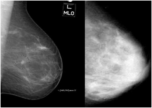 Two mammograms side by side: a fatty breast appears mostly dark, a dense breast mostly white