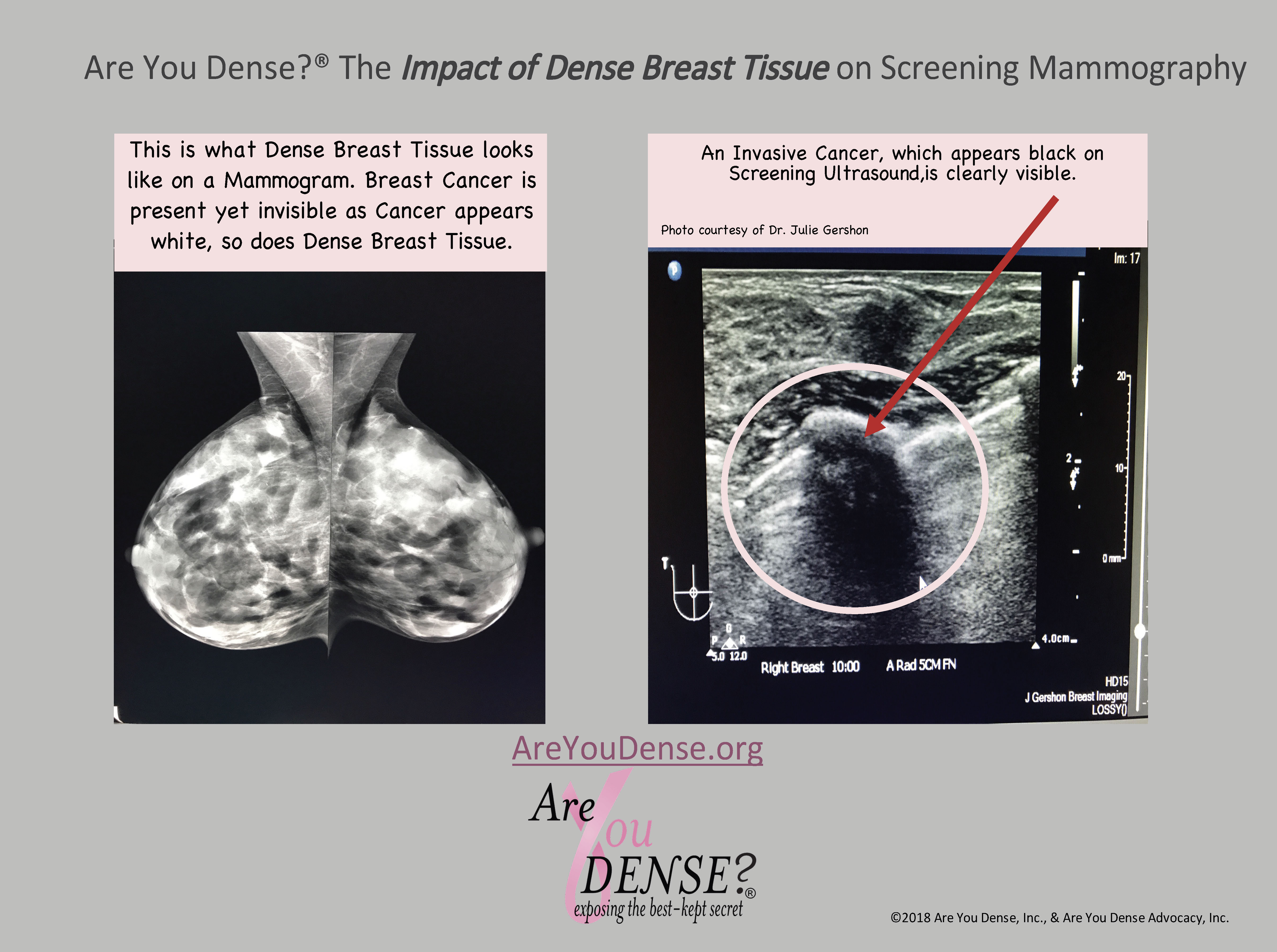 Dense tissue and cancer both look white on a mammogram; ultrasound clearly shows the same invasive cancer as black